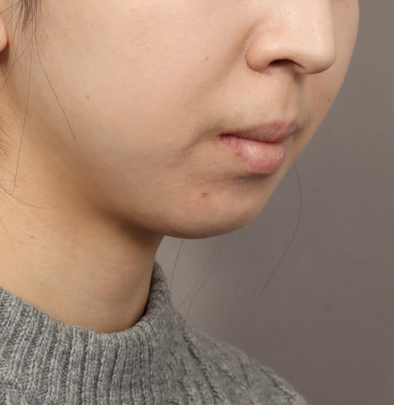 Before Image: Genioplasty – Chin Implant (5 Months Post-Op) - right-front-oblique