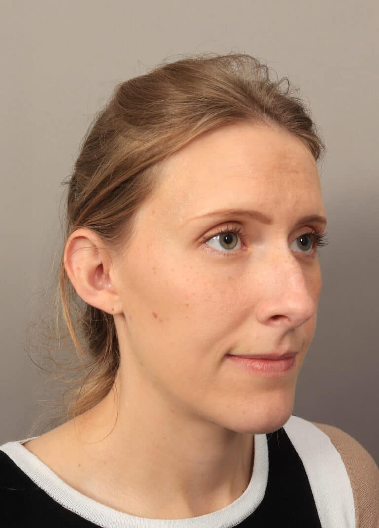 Before Image: Rhinoplasty (6 Months Post-Op) - right-front-oblique