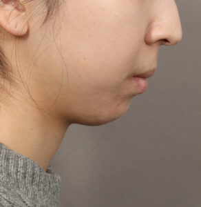 Before Image: Genioplasty – Chin Implant (5 Months Post-Op)