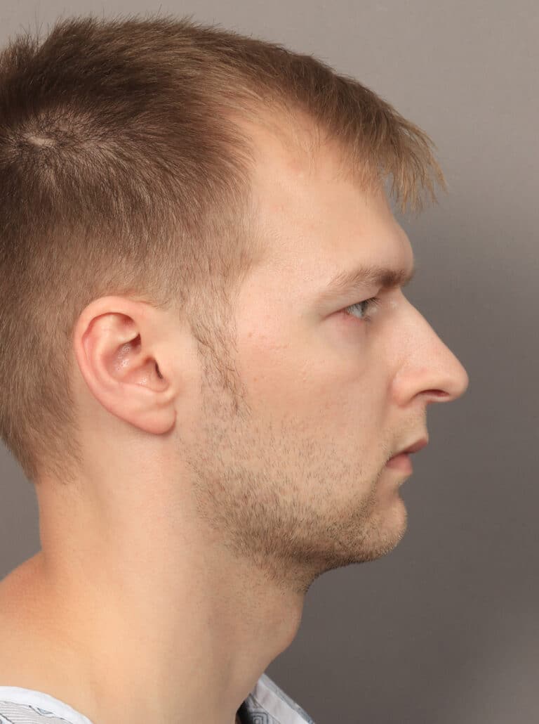Before Image: Jaw and Chin Augmentation (1 Year, 9 Months Post-Op) - right-side
