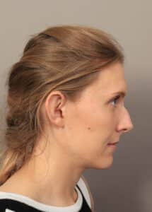 Before Image: Rhinoplasty (6 Months Post-Op)
