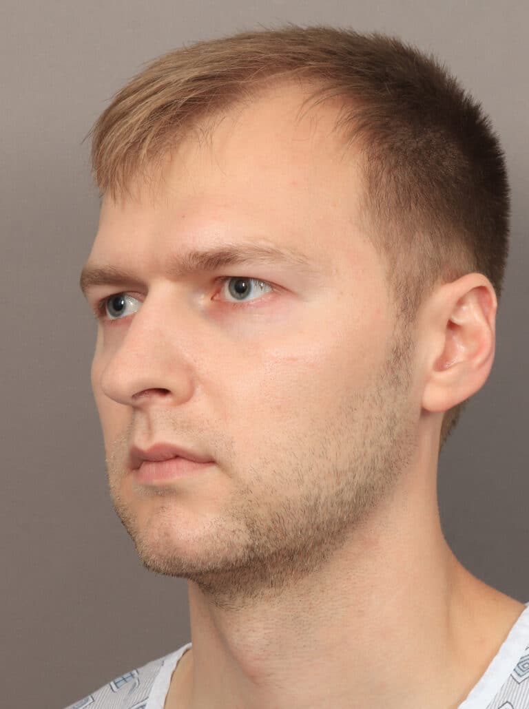 Before Image: Jaw and Chin Augmentation (1 Year, 9 Months Post-Op) - left-front-oblique
