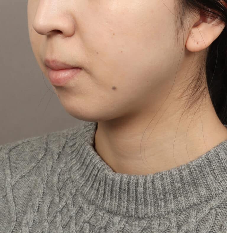 Before Image: Genioplasty – Chin Implant (5 Months Post-Op) - left-front-oblique