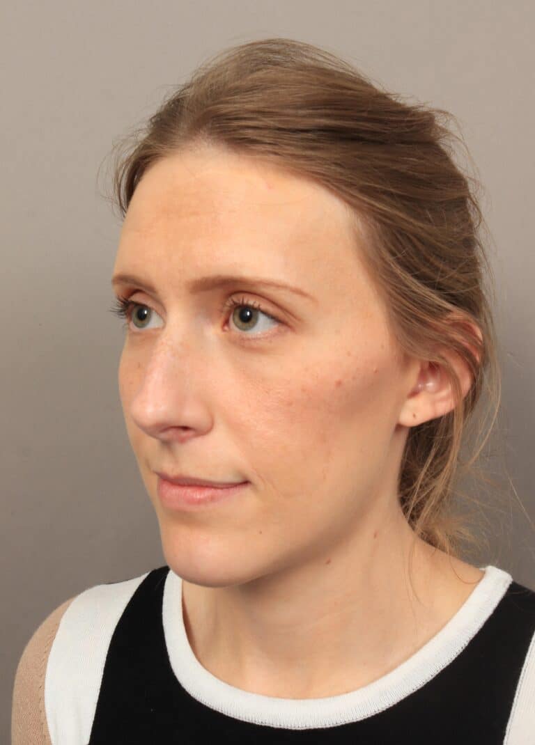 Before Image: Rhinoplasty (6 Months Post-Op) - left-front-oblique