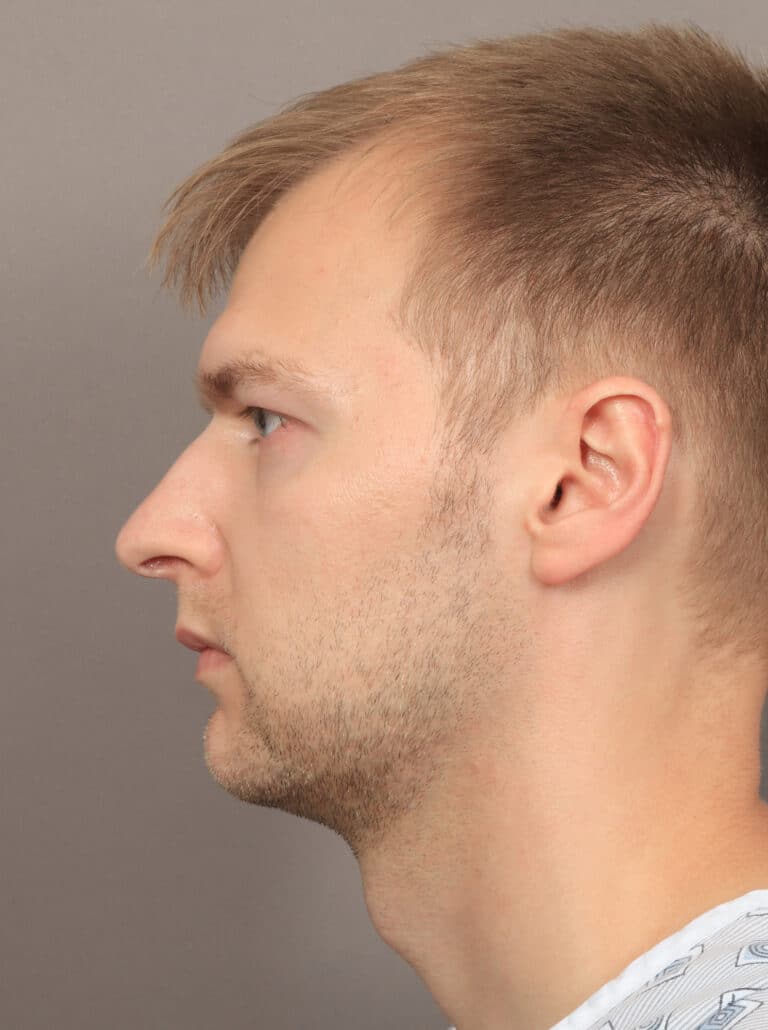 Before Image: Jaw and Chin Augmentation (1 Year, 9 Months Post-Op) - left-side