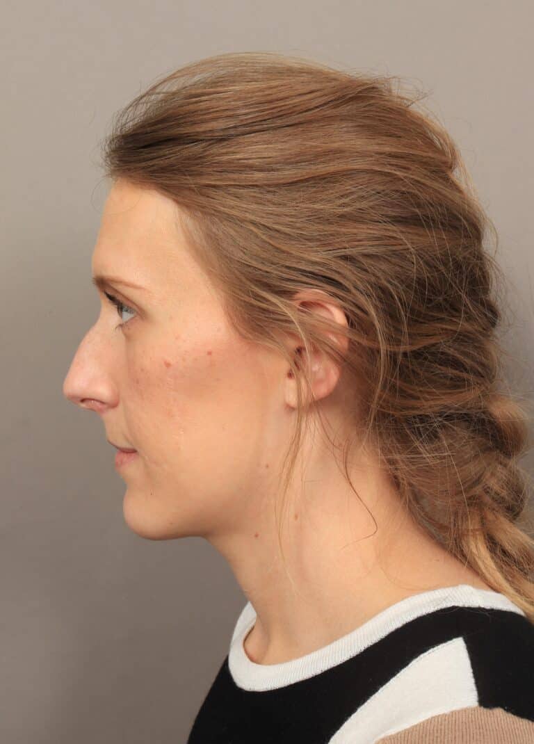 Before Image: Rhinoplasty (6 Months Post-Op) - left-side