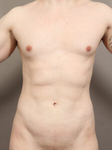 After Image: High Definition VASER Liposuction and Renuvion (2 Years Post-Op)