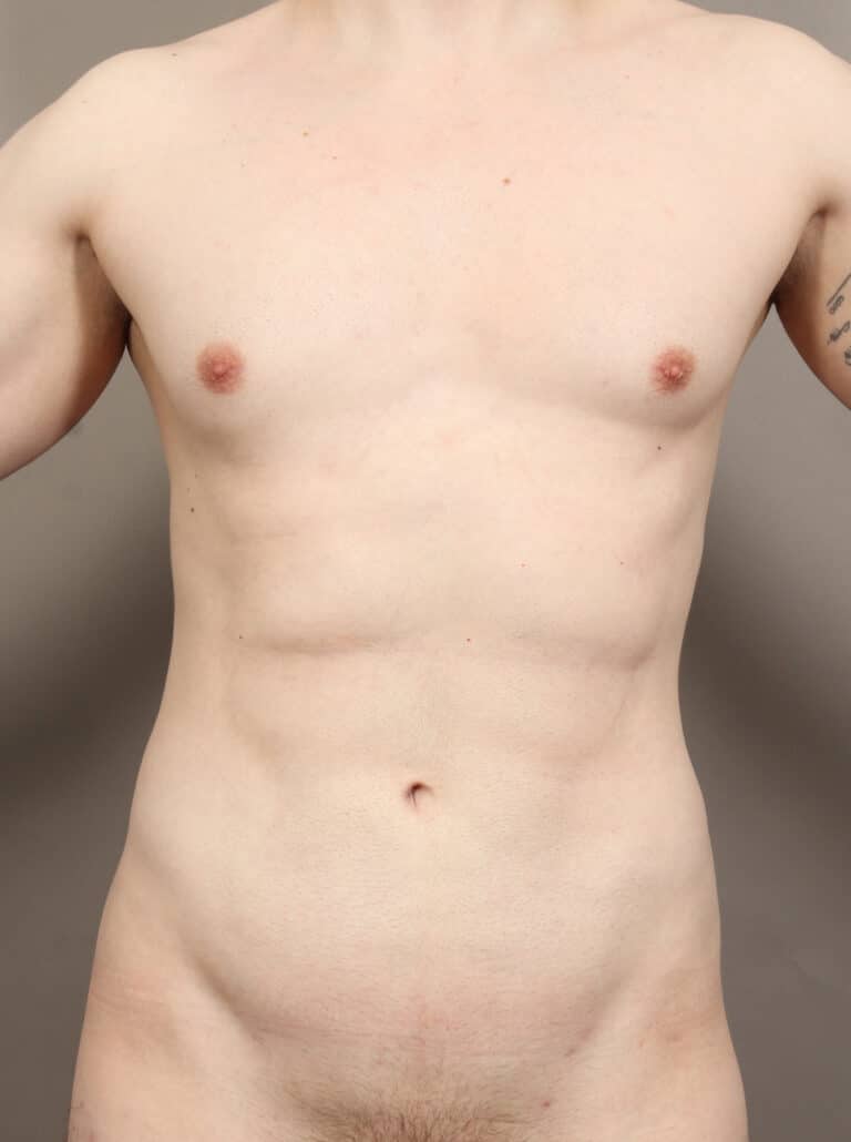 After Image: High Definition VASER Liposuction and Renuvion (2 Years Post-Op) - front