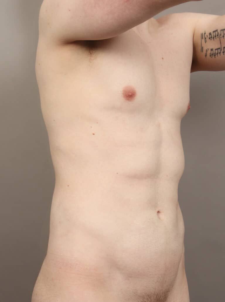 After Image: High Definition VASER Liposuction and Renuvion (2 Years Post-Op) - right-front-oblique