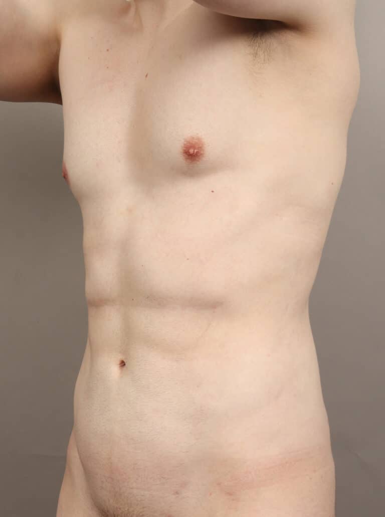 After Image: High Definition VASER Liposuction and Renuvion (2 Years Post-Op) - left-front-oblique