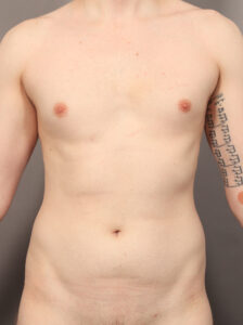 Before Image: High Definition VASER Liposuction and Renuvion (2 Years Post-Op)