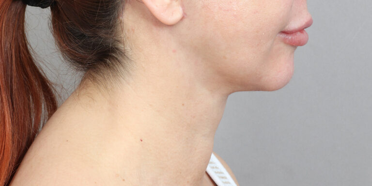 After Image: Neck Lift (2 Months Post-Op) - right-side