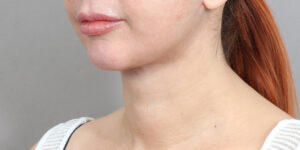 After Image: Neck Lift (2 Months Post-Op)