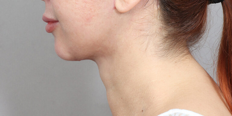 After Image: Neck Lift (2 Months Post-Op) - left-side