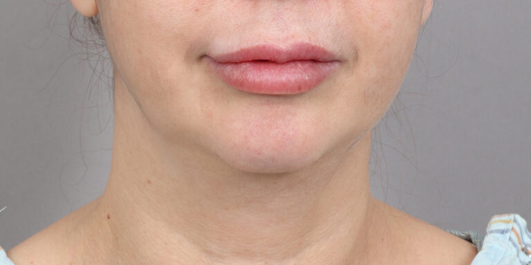 Before Image: Neck Lift (2 Months Post-Op) - front