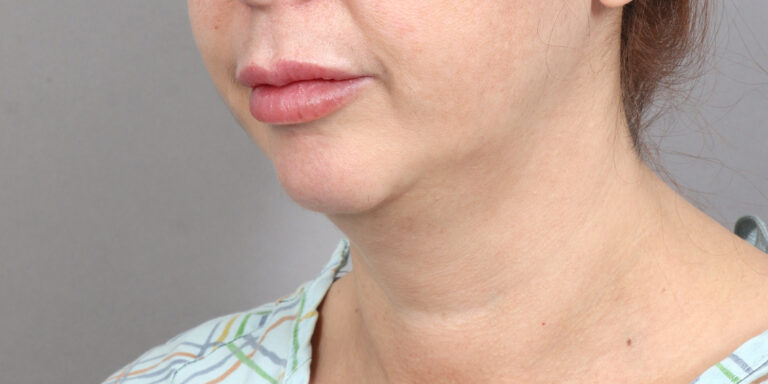 Before Image: Neck Lift (2 Months Post-Op) - left-front-oblique