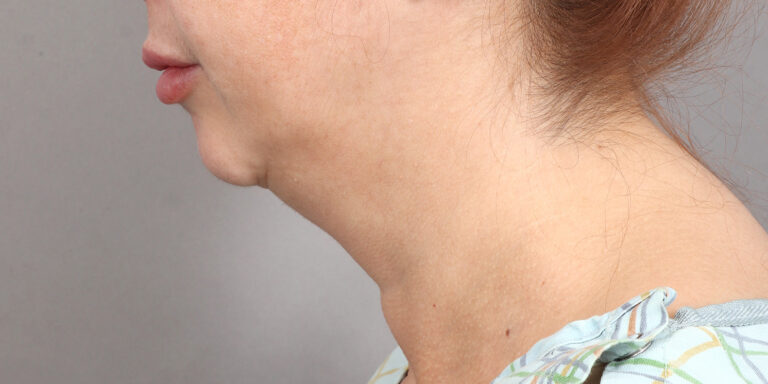 Before Image: Neck Lift (2 Months Post-Op) - left-side