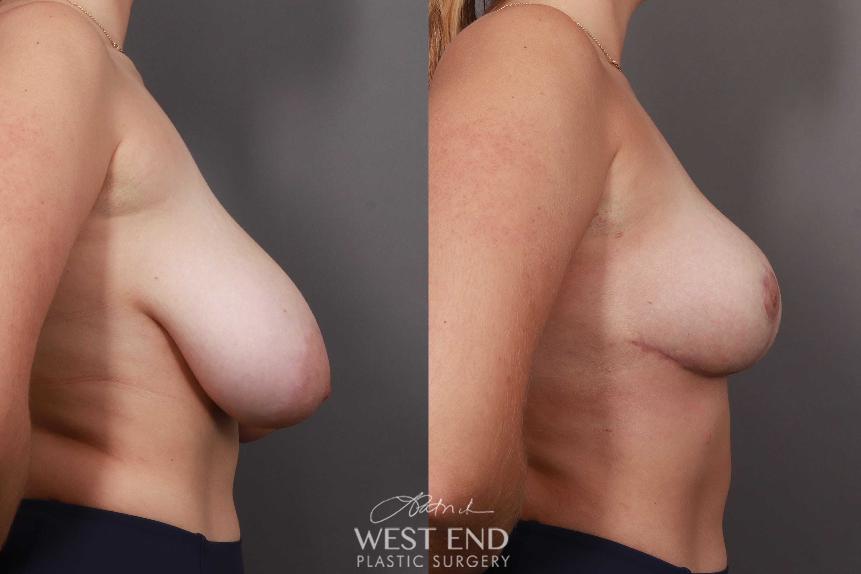 Breast Reduction (4 Months Post-Op)