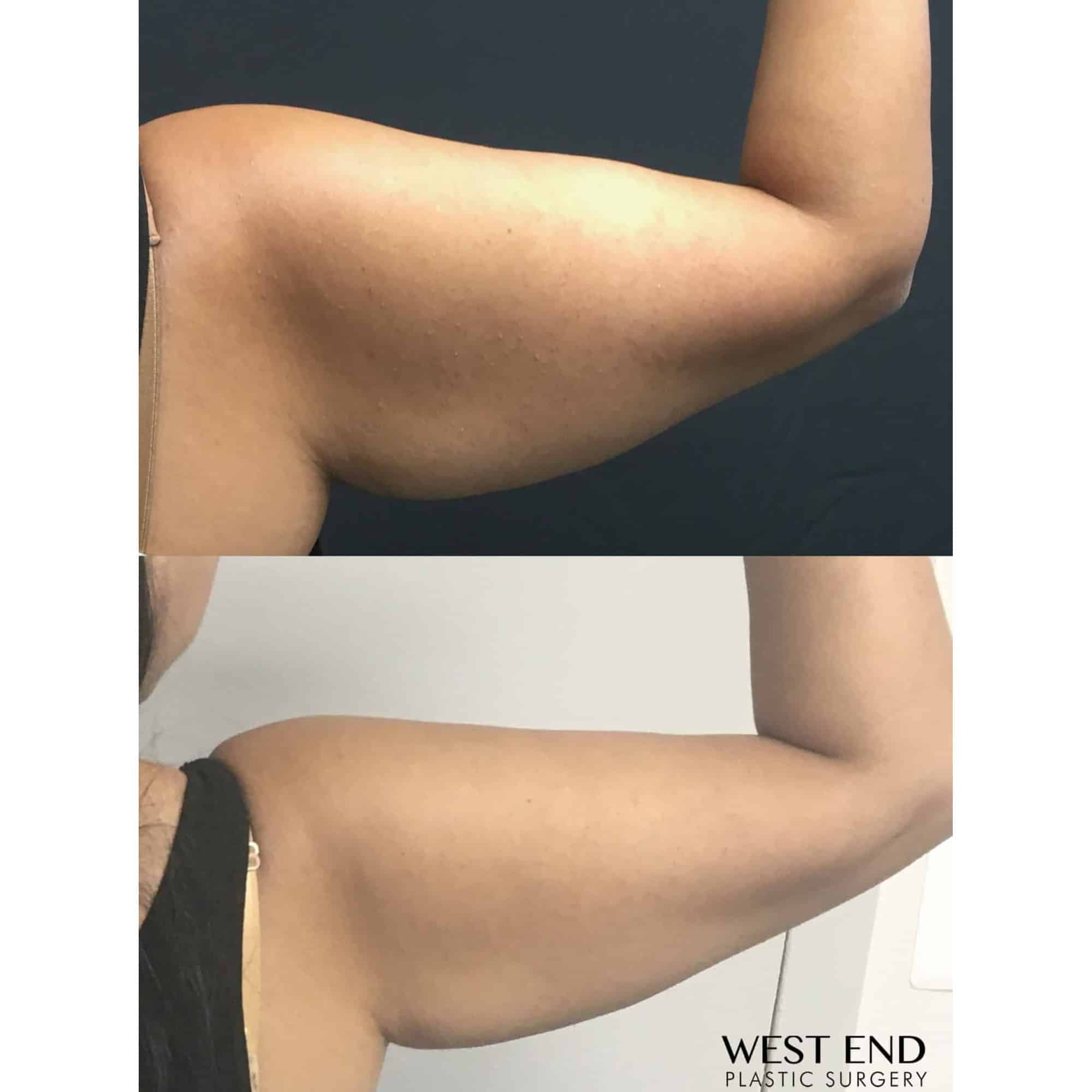CoolSculpting