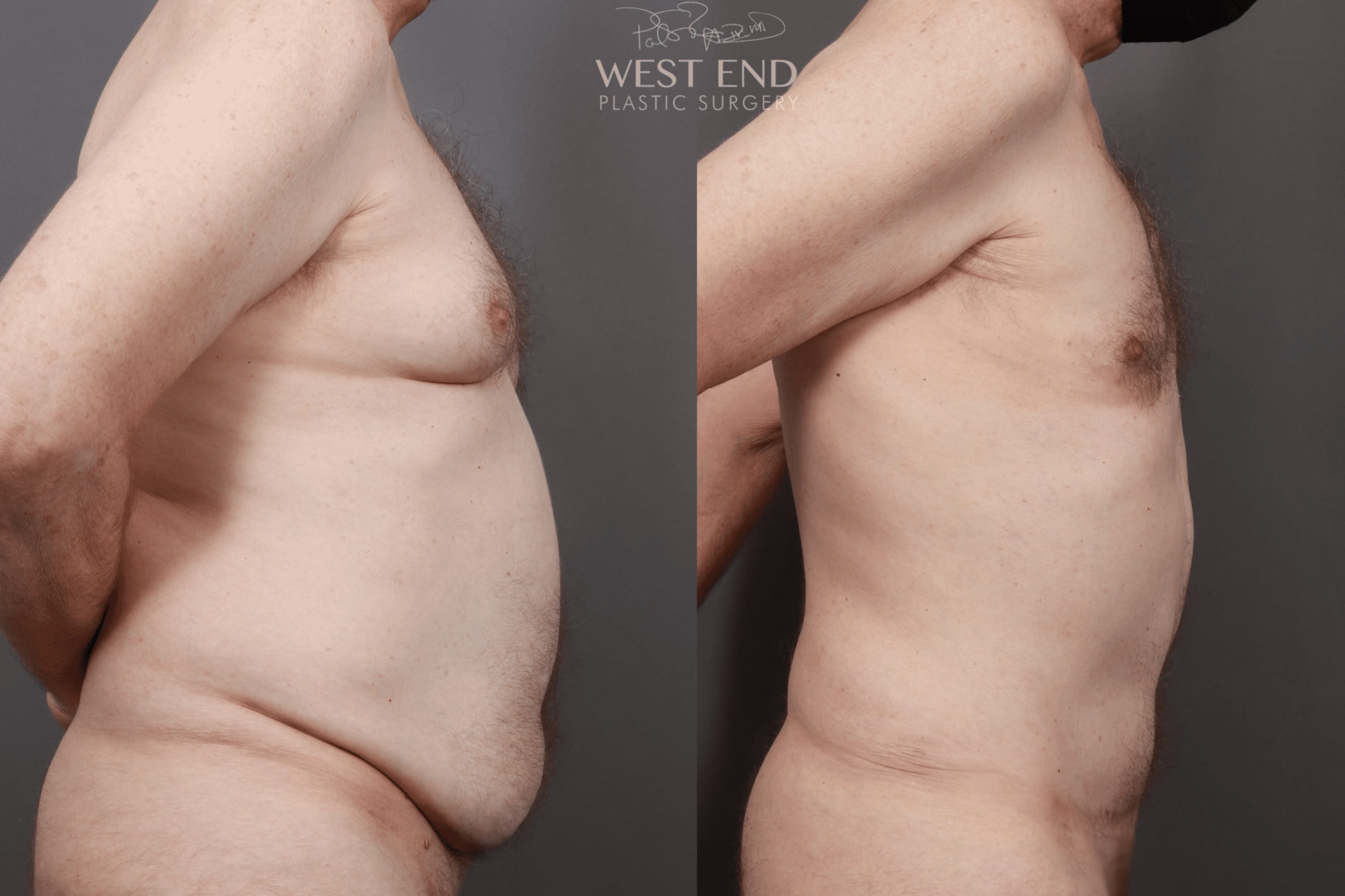 Tummy Tuck, Liposuction, & Renuvion Skin Tightening (1 Year Post-Op)