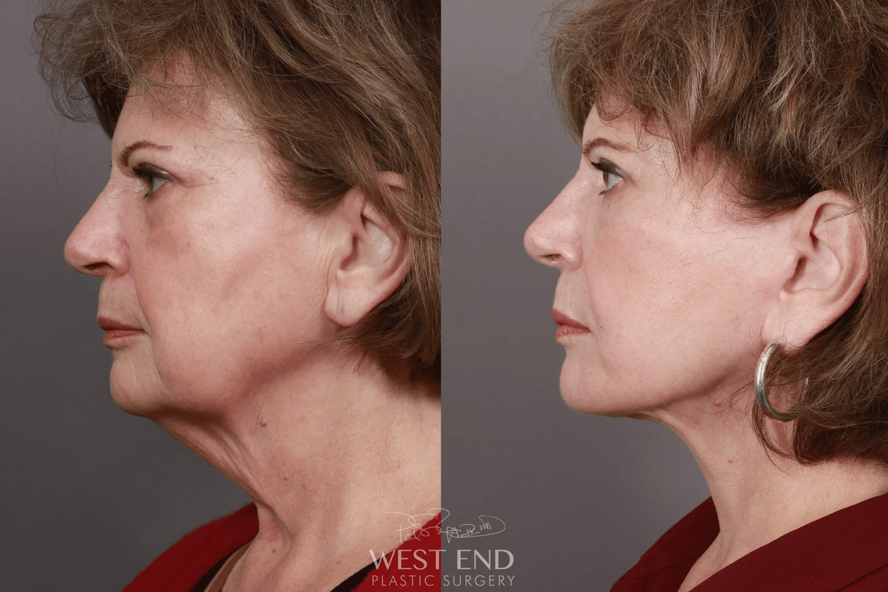 Deep Plane Facelift & Neck Lift, Brow Lift, Eyelid Lift, Fat Grafting, and CO2 Resurfacing (5 Months Post-Op)