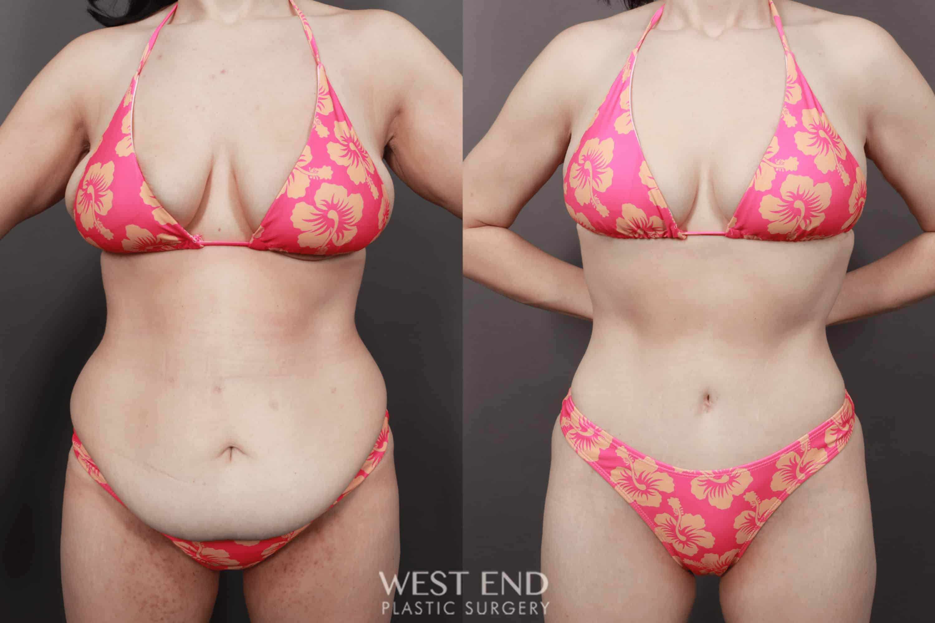 Post Weight Loss: Breast Lift, Tummy Tuck, Liposuction, & Renuvion Skin Tightening (10 Months Post-Op)