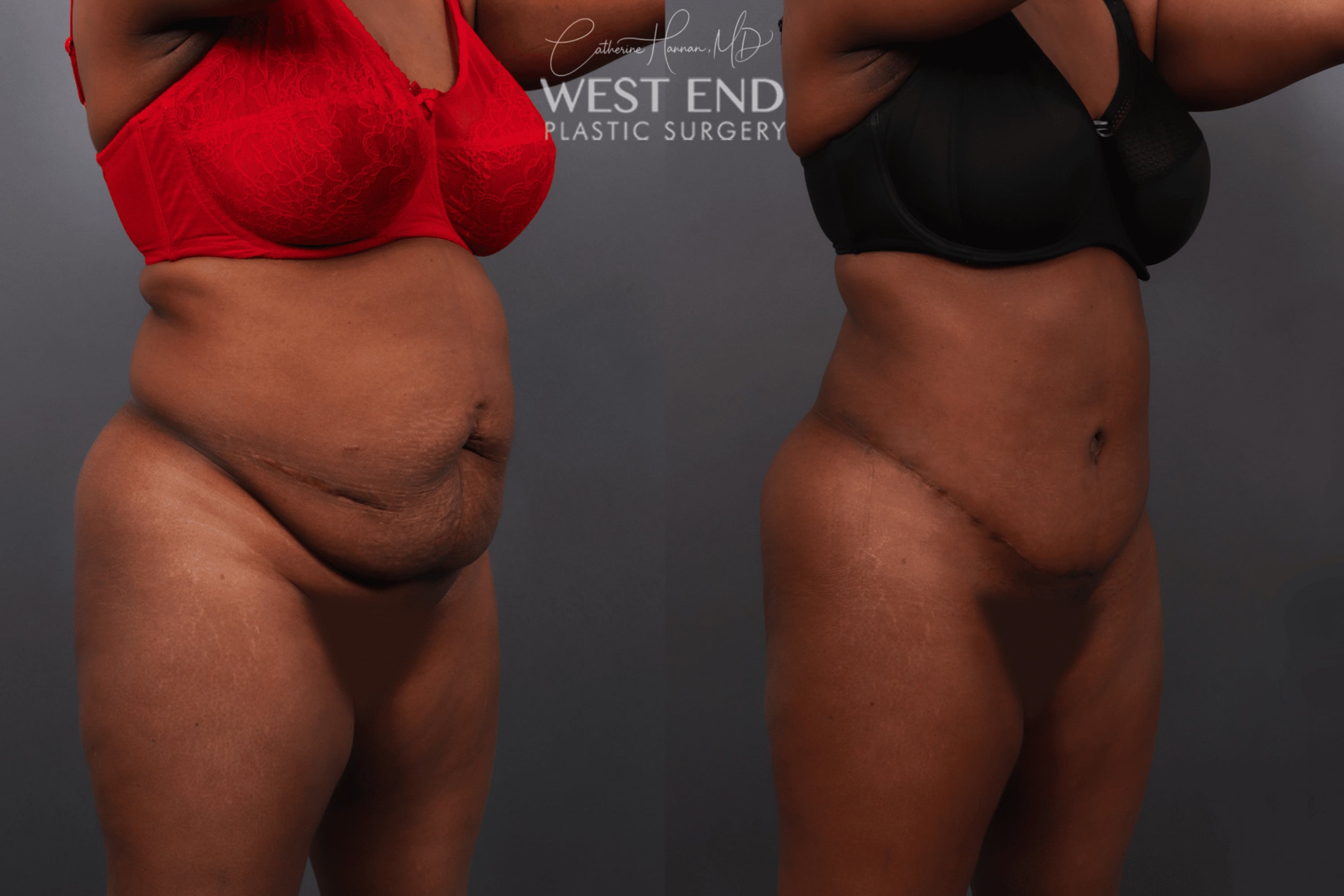 Tummy Tuck & Liposuction