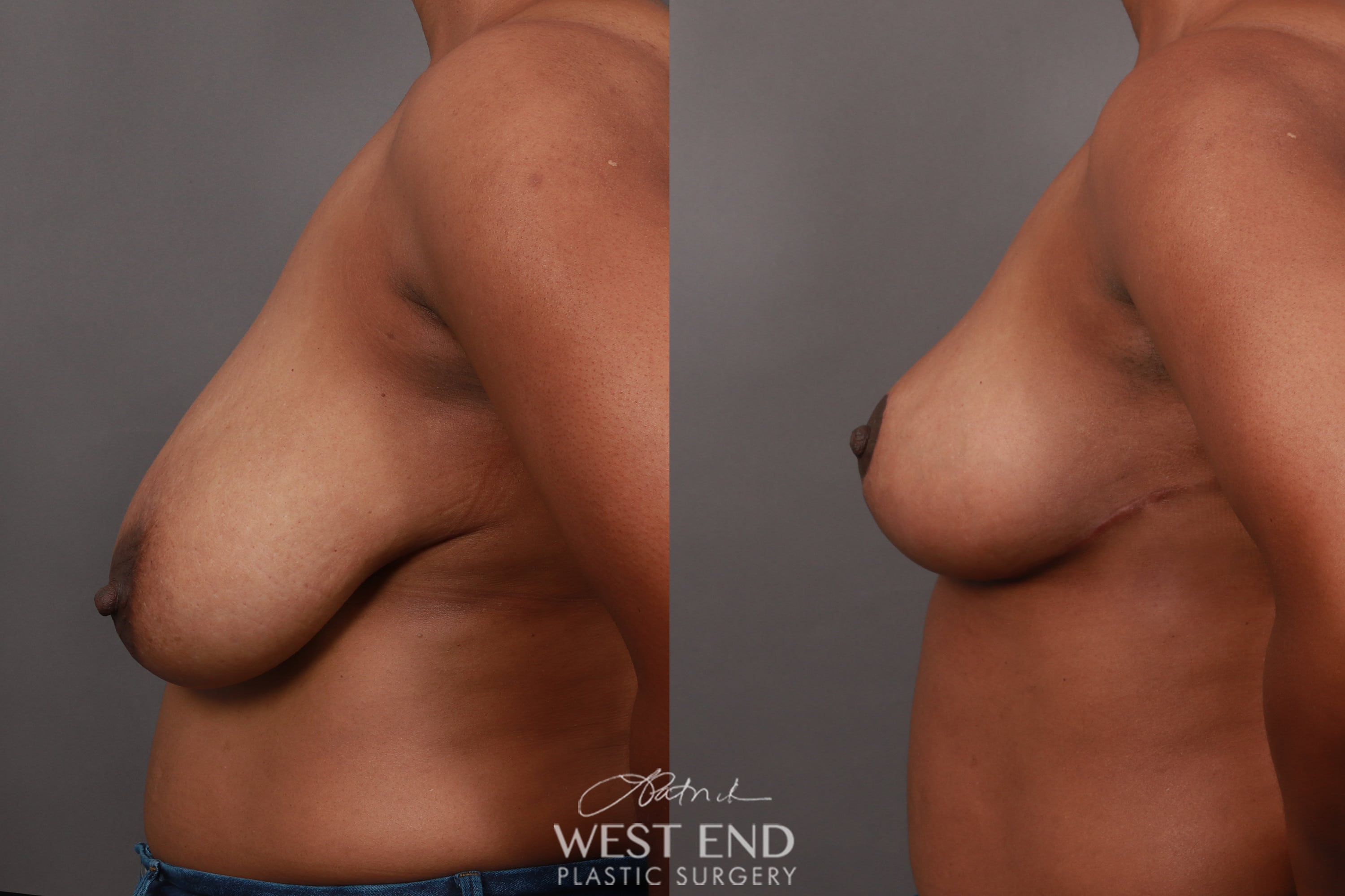 Breast Reduction (3.5 Months Post-Op)