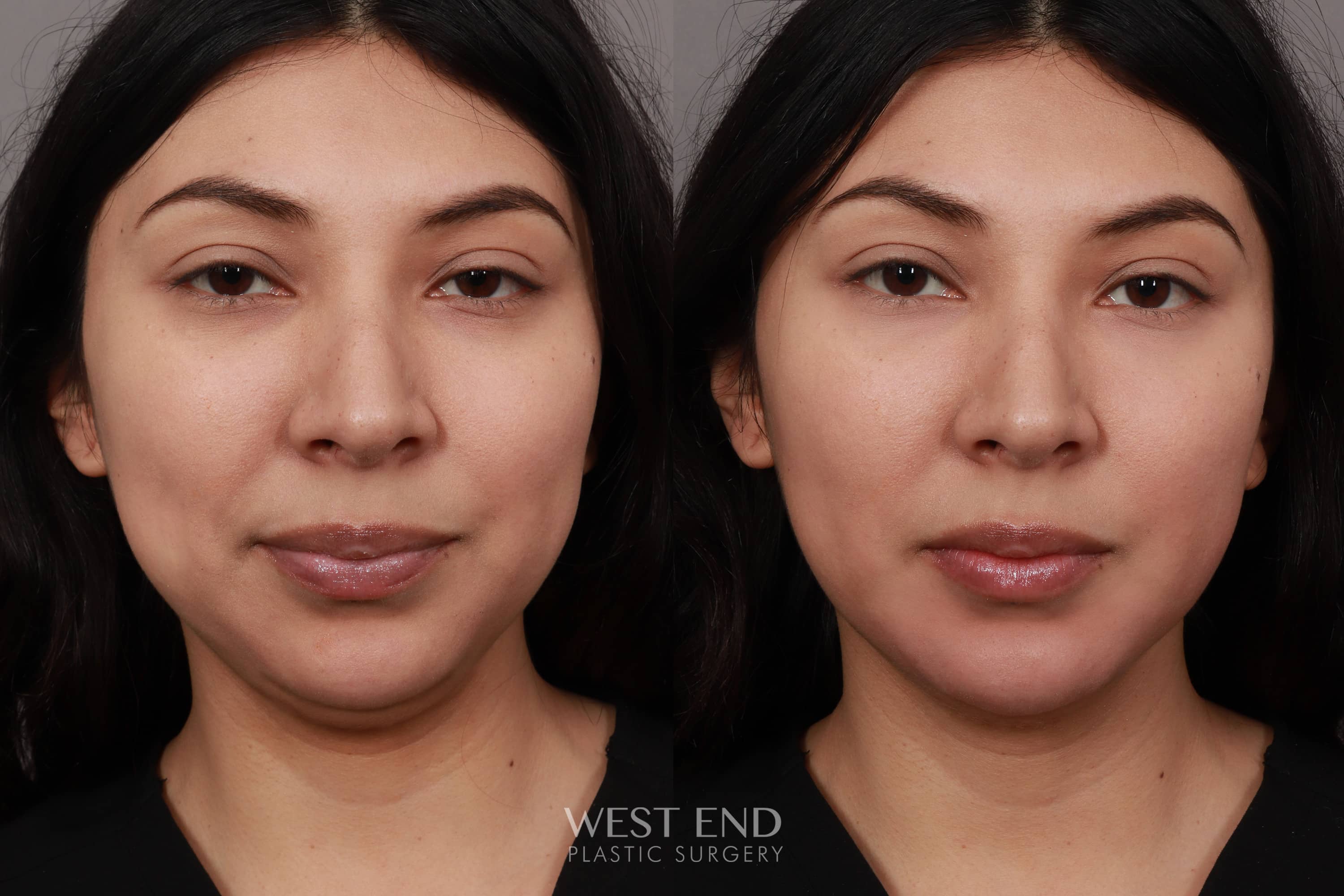 Jawline Filler (Juvederm Volux)