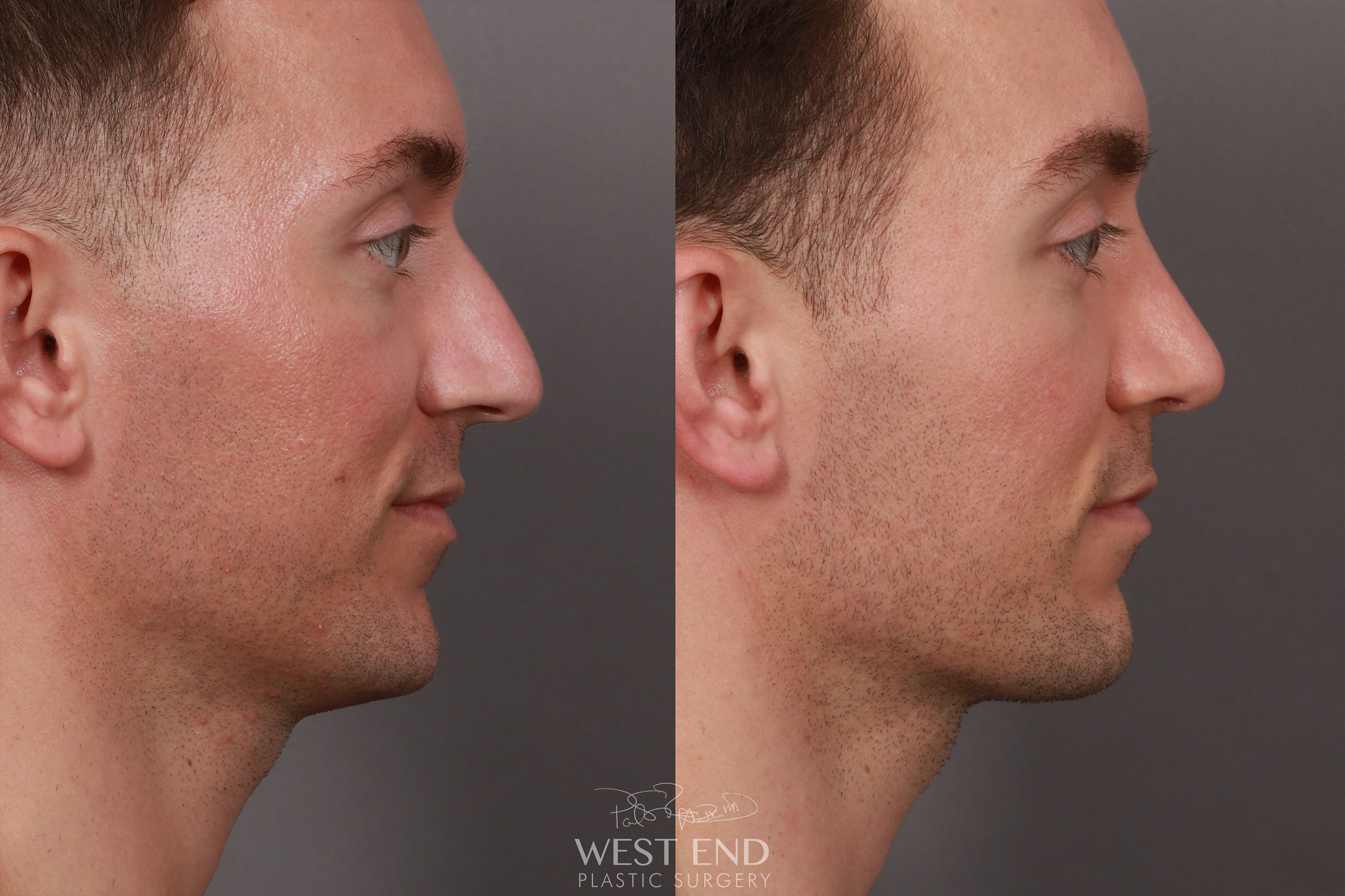 Structural Rhinoplasty (3 Months Post-Op)