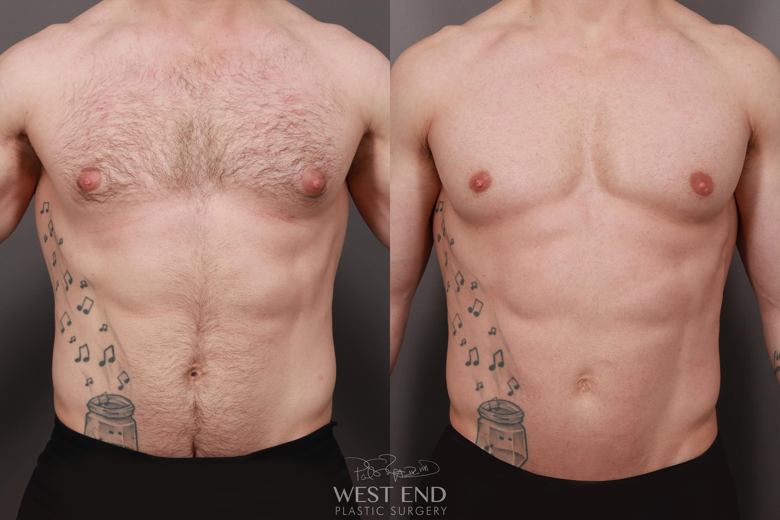 Gynecomastia (using Liposuction & Renuvion) (3 Months Post-Op)