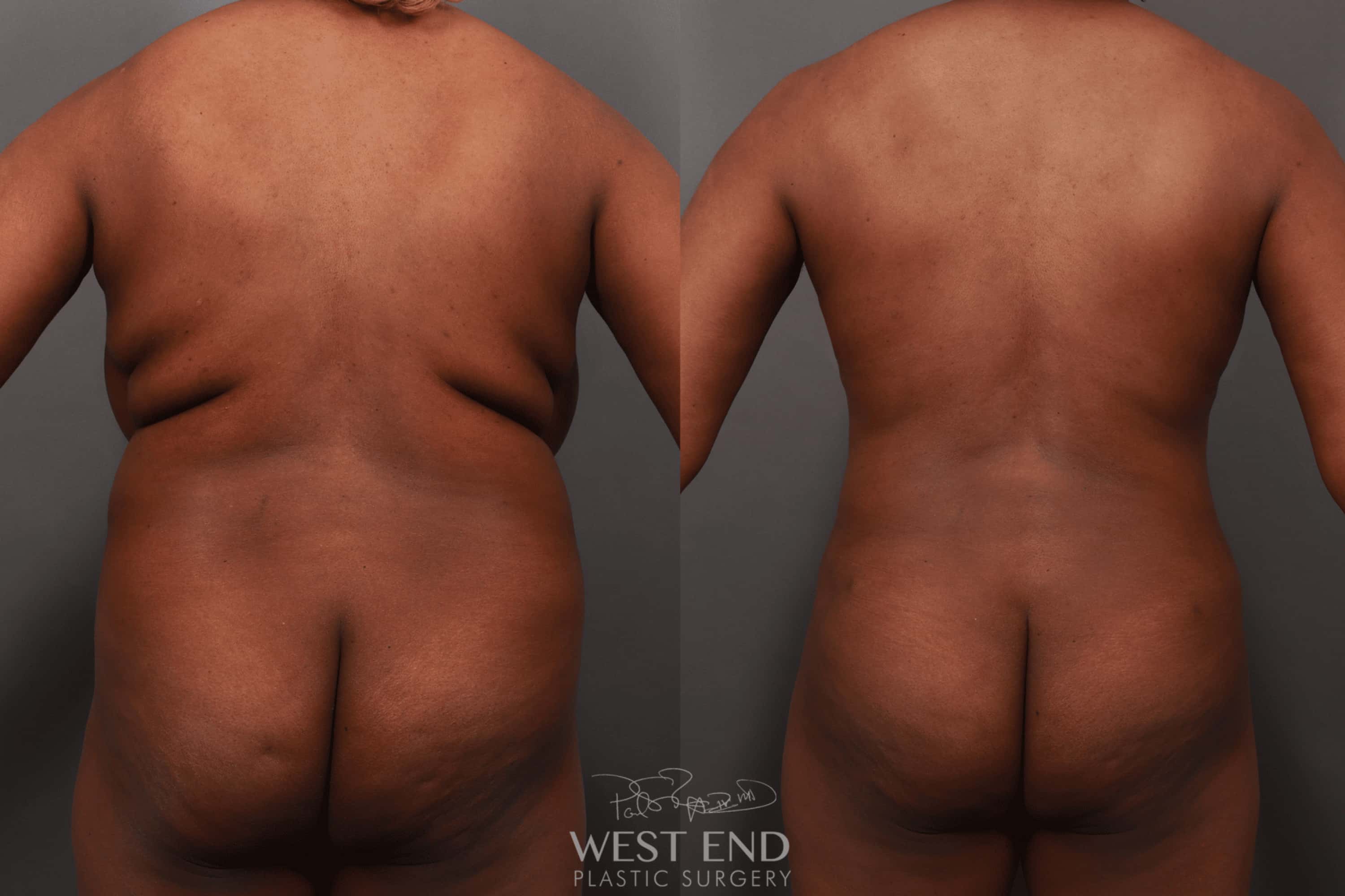 Breast Reduction, Liposuction, & Renuvion Skin Tightening (10 Months Post-Op)