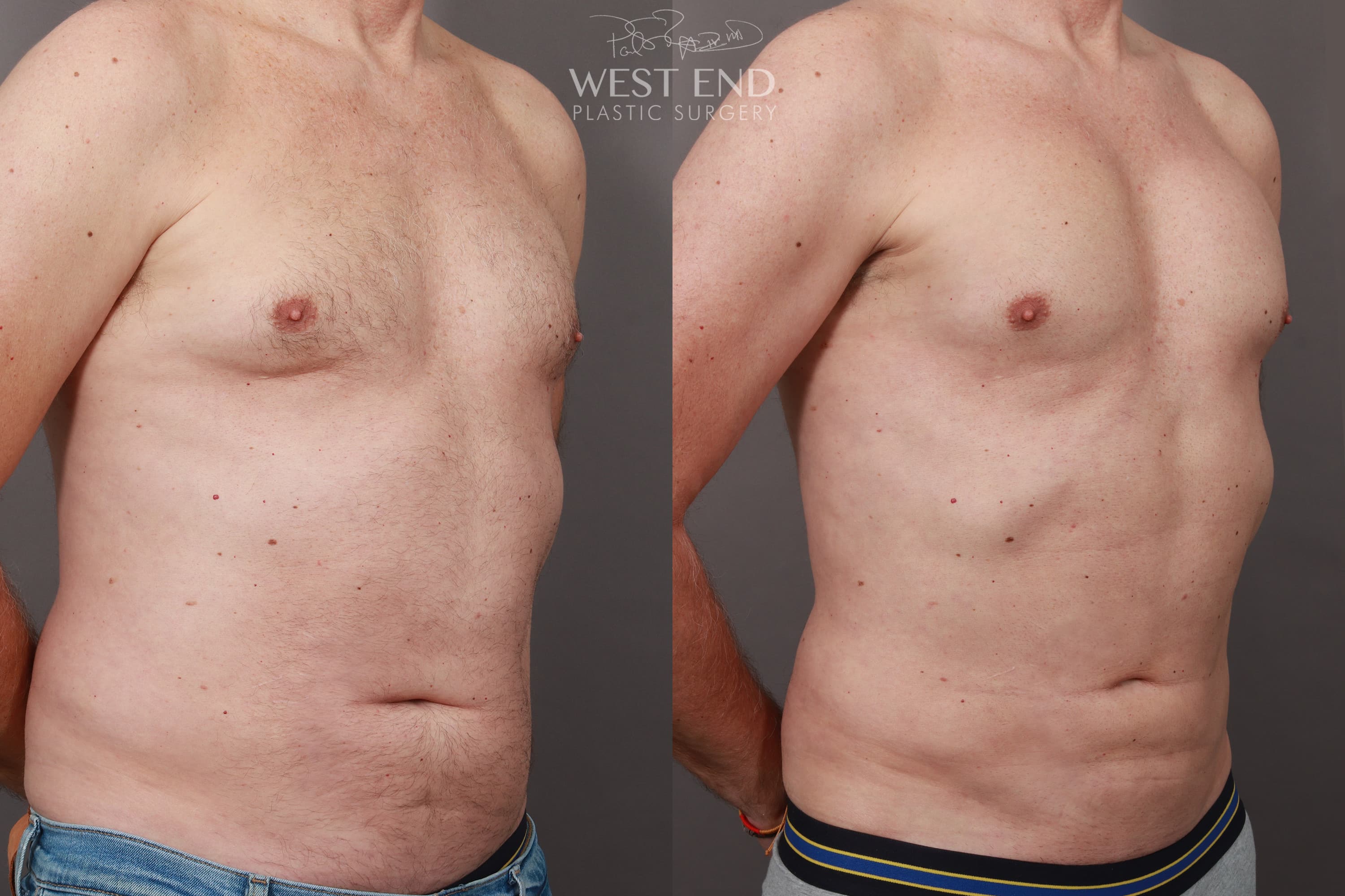 Pectoral Implants, Liposuction, & Renuvion Skin Tightening (2 months Post-Op)