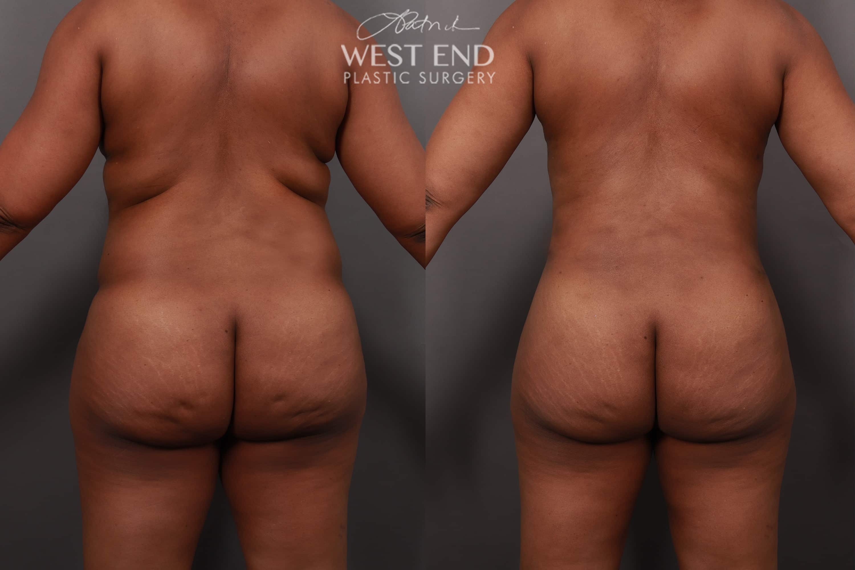 Extended Tummy Tuck and Liposuction (1 Month Post-Op)