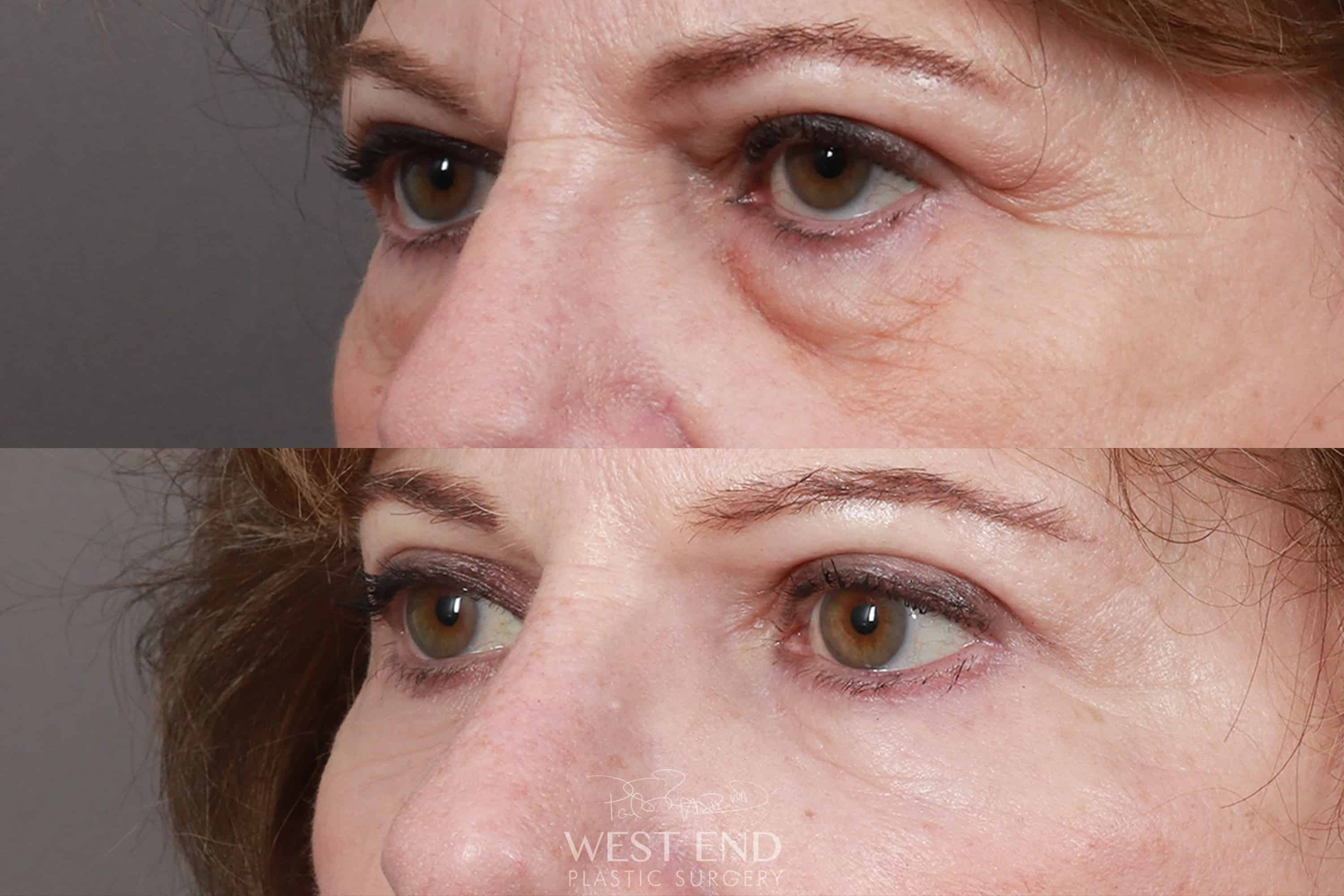 Lower & Upper Blepharoplasty