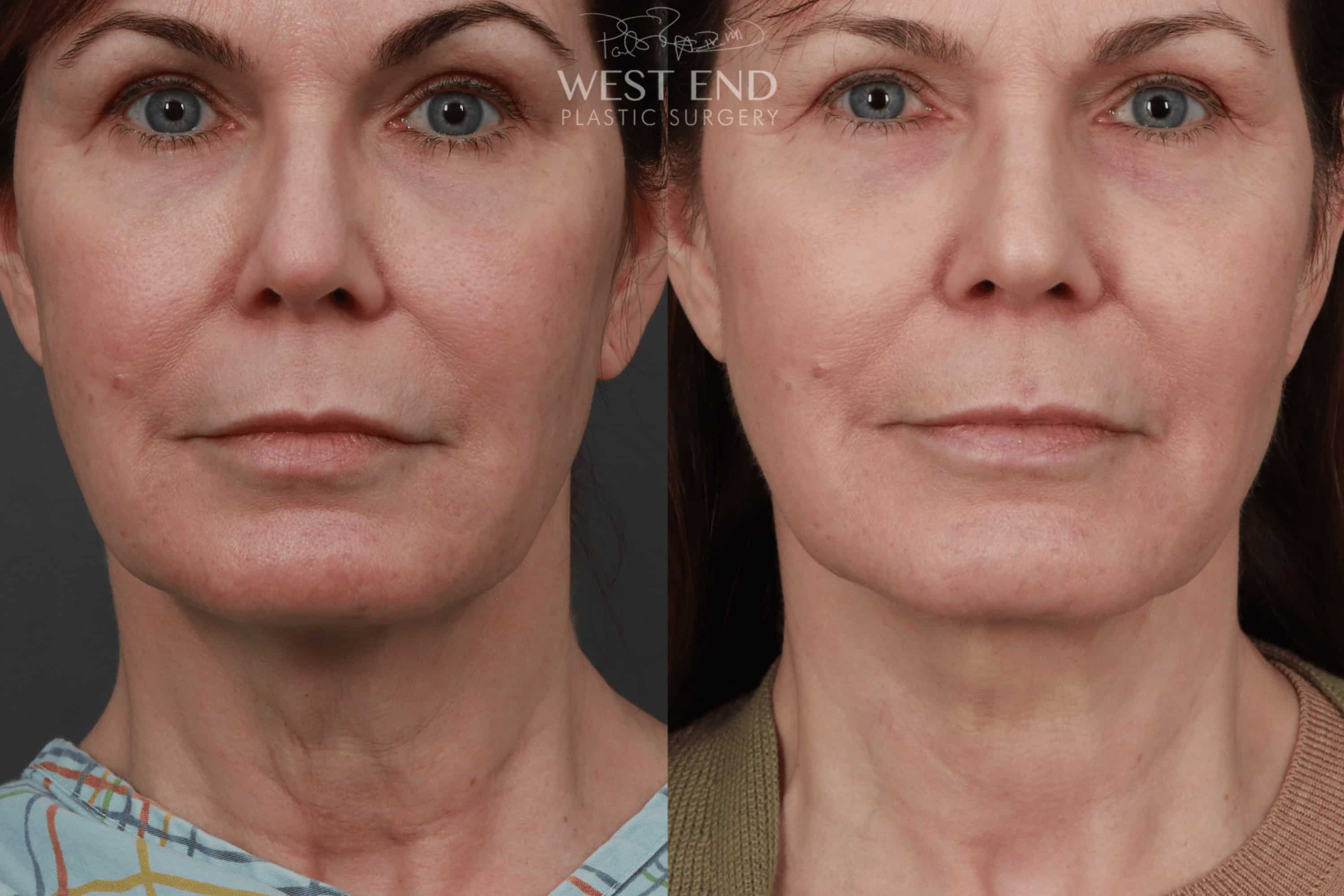 Deep Plane Neck Lift (9 Months Post-Op)