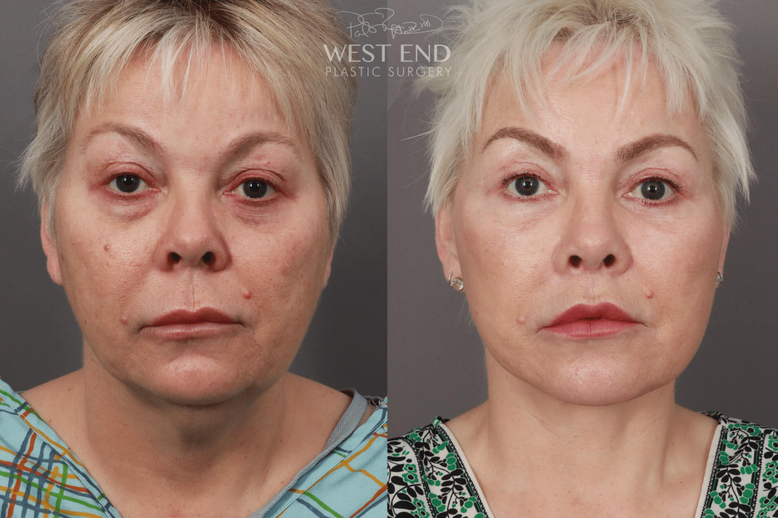 Deep Plane Facelift & Neck Lift, Eyelid Lift, Lip Lift, and Fat Grafting (9 Months Post-Op)