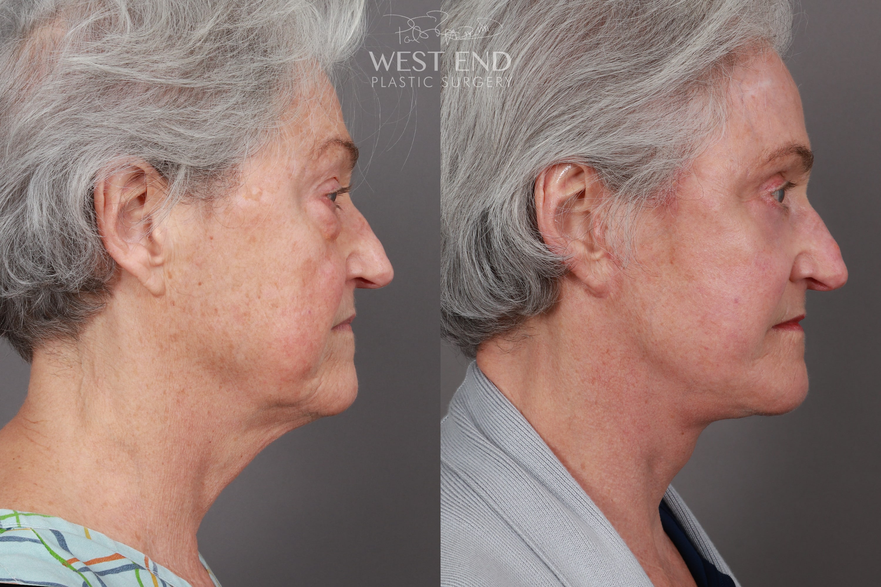 Deep Plane Facelift & Neck Lift, Eyelid Lift, Fat Grafting, and CO2 Resurfacing (1 Year Post-Op)