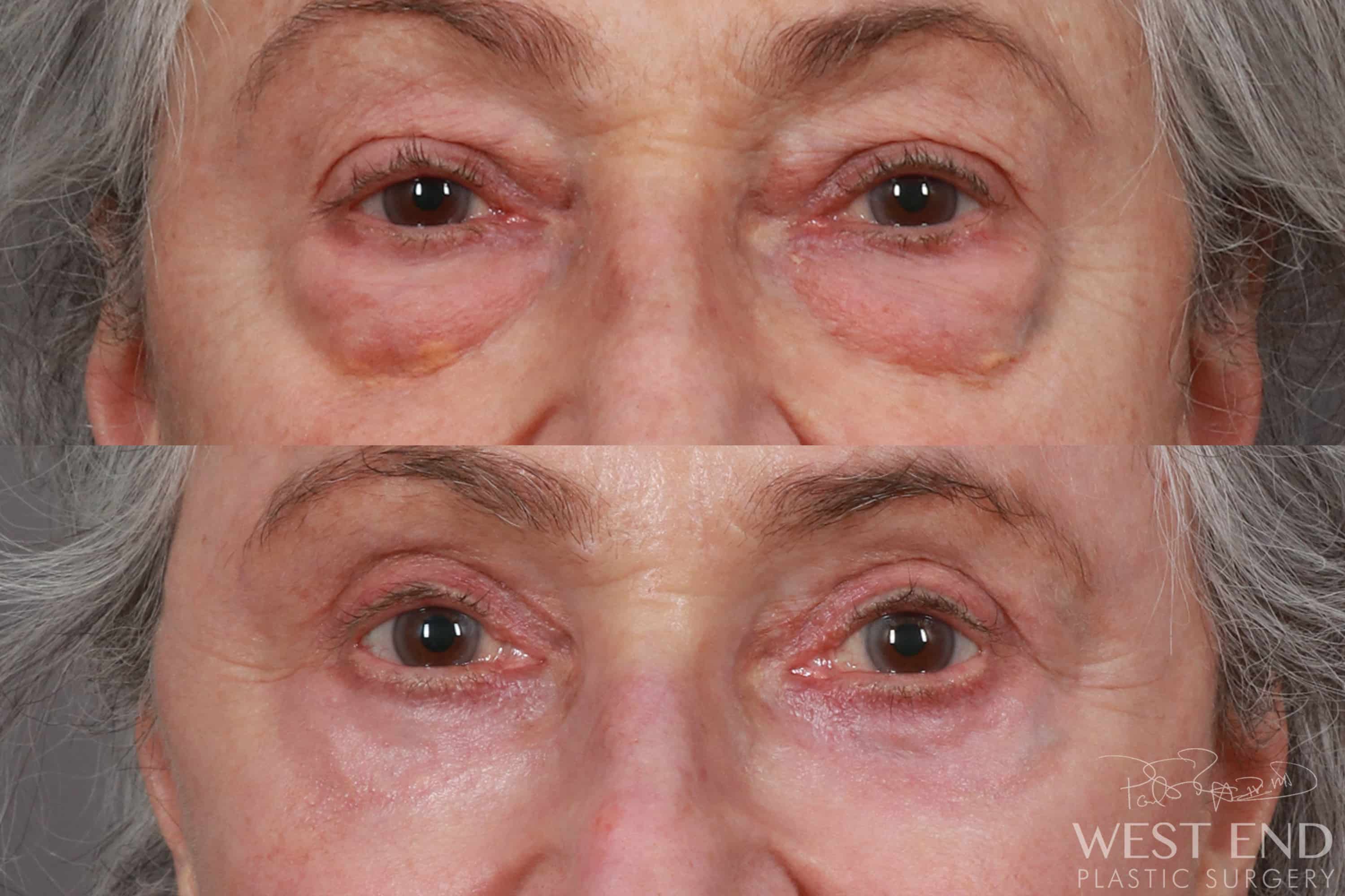 Lower & Upper Blepharoplasty before photo. Individual results may vary.