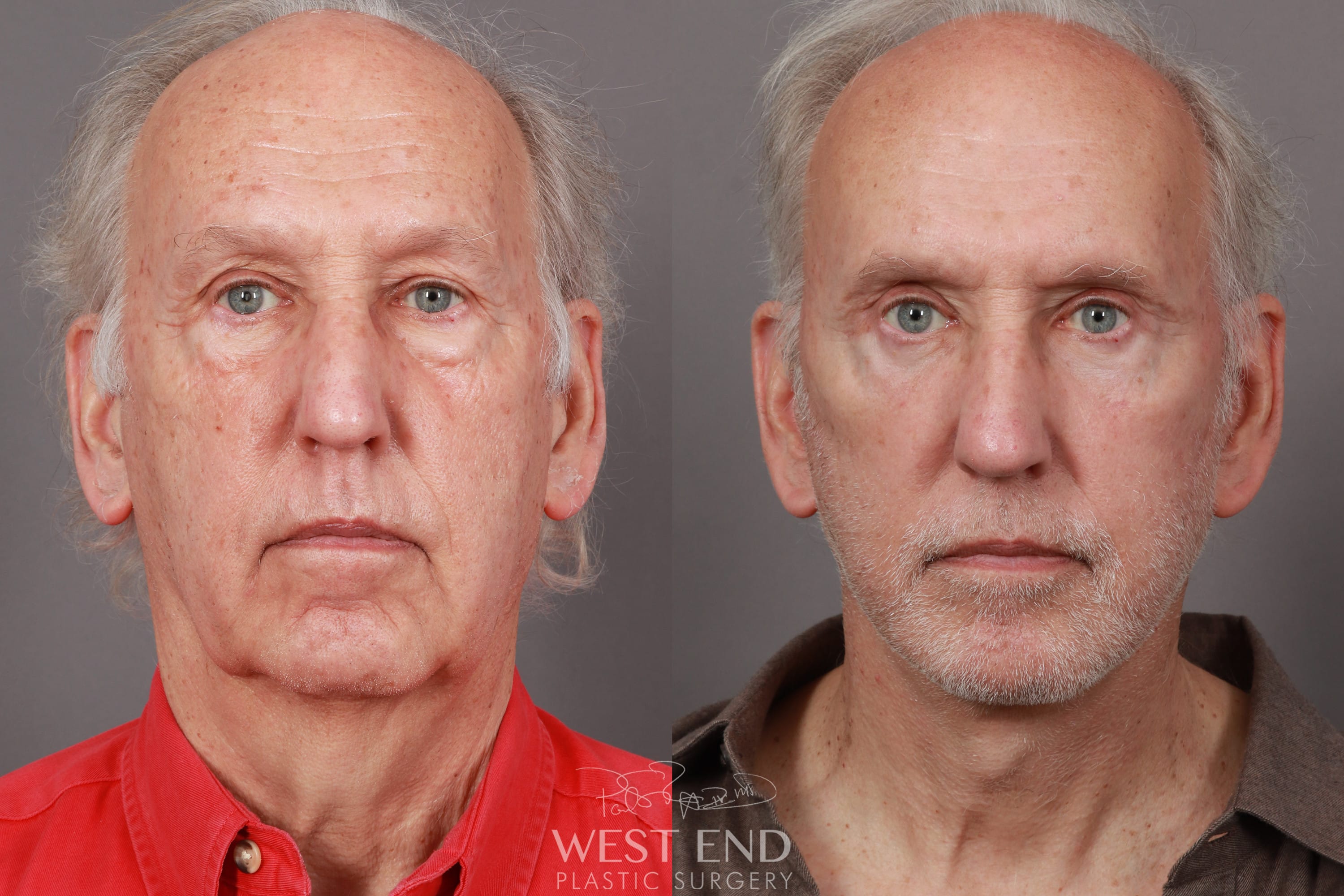 Orange County Facial Rejuvenation Surgery