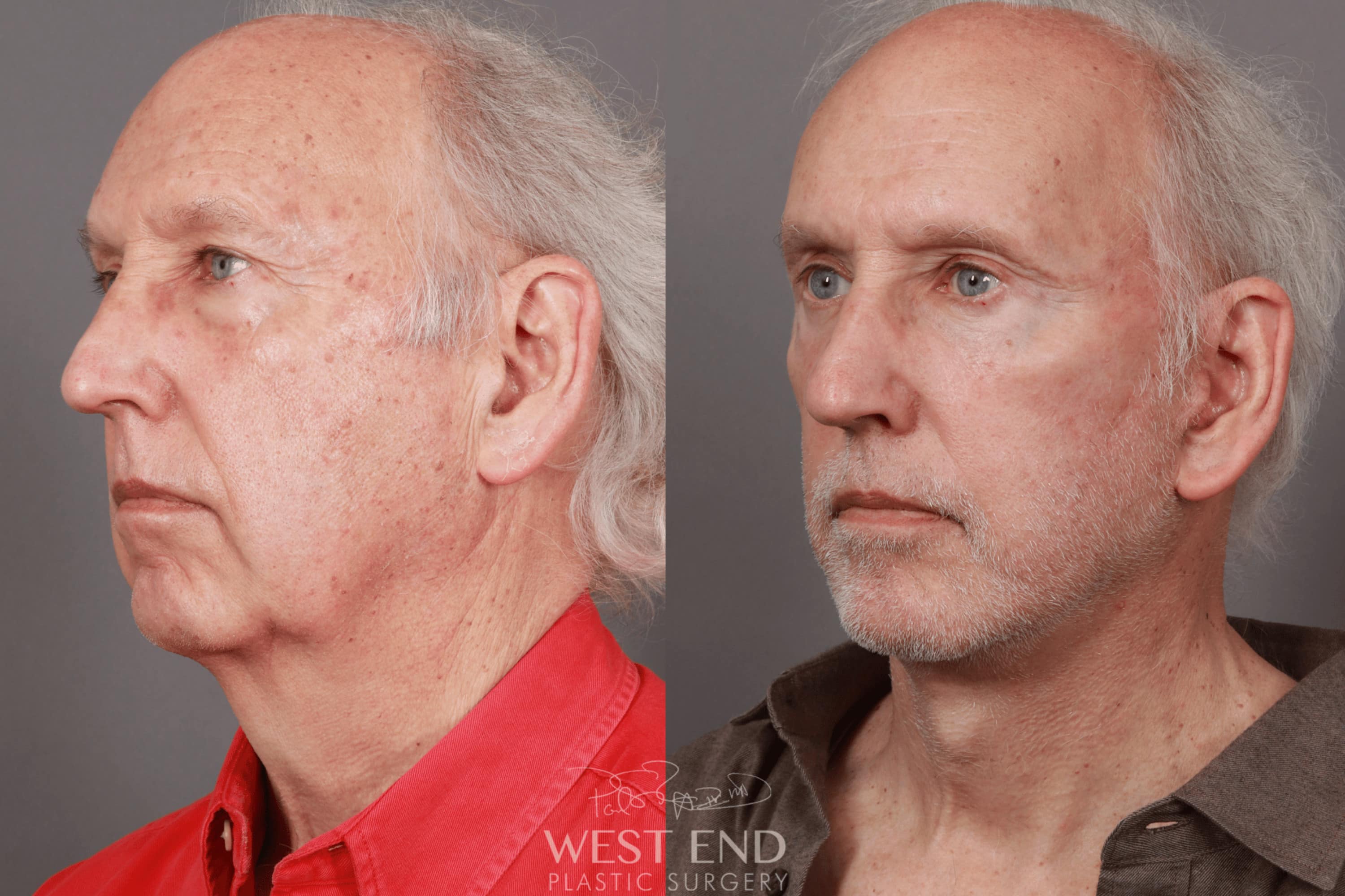 Deep Plane Facelift & Neck Lift, Eyelid Lift, Fat Grafting, and CO2 Resurfacing (5 Months Post-Op)