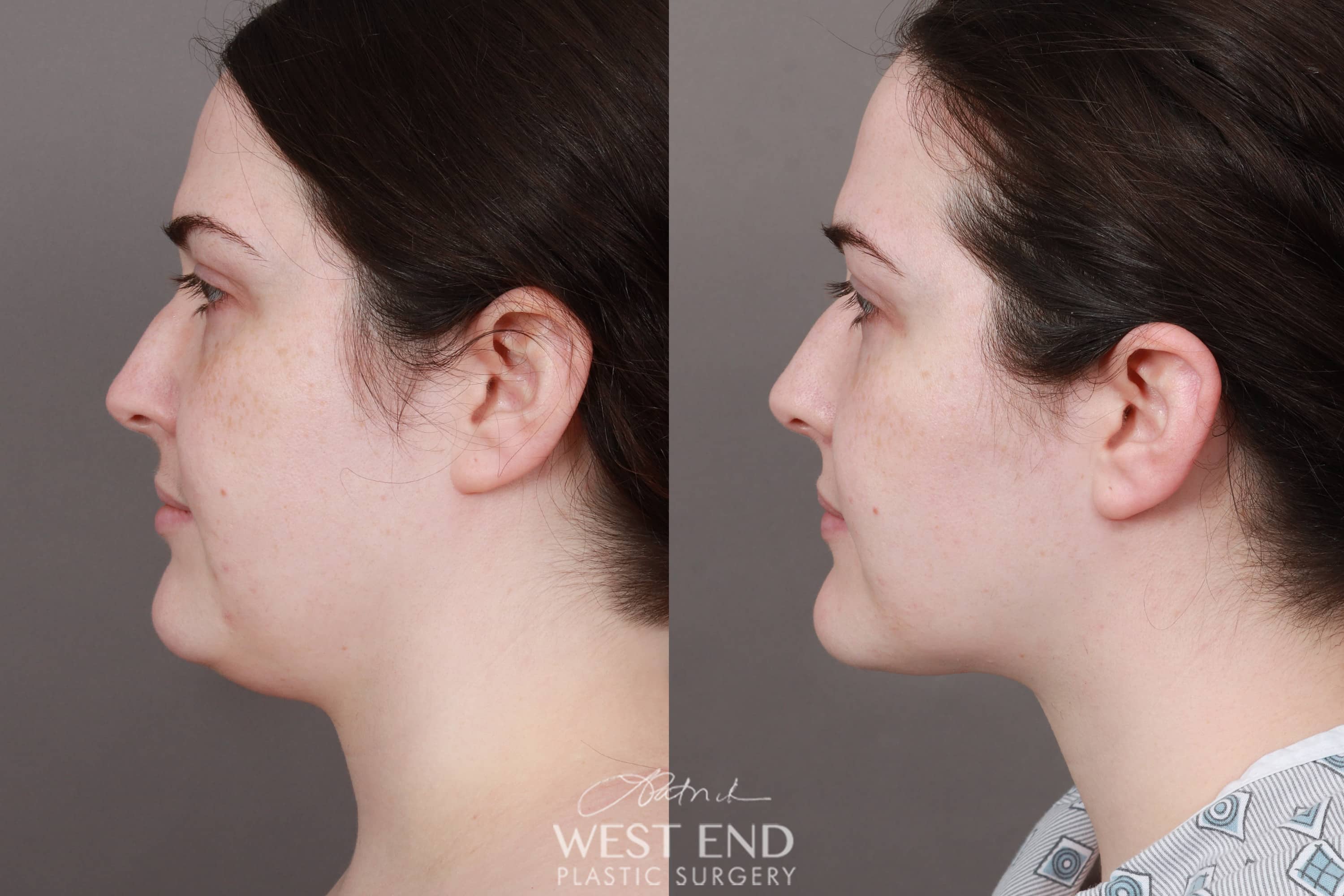 Liposuction of the Submental, Jawline, and Neck Region (3.5 Months Post-Op)