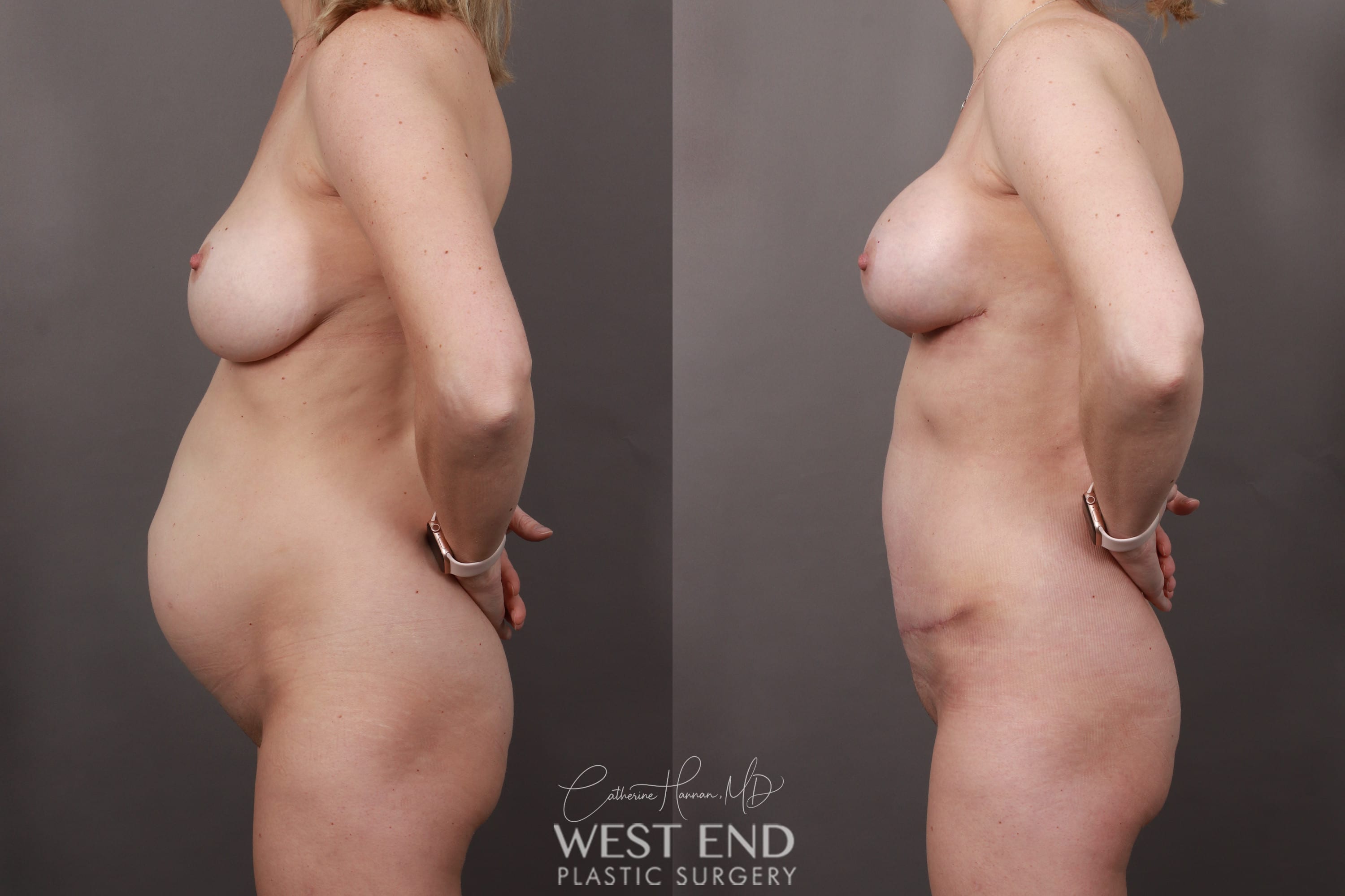 Mommy Makeover (Tummy Tuck with Liposuction & Breast Implant Exchange)
