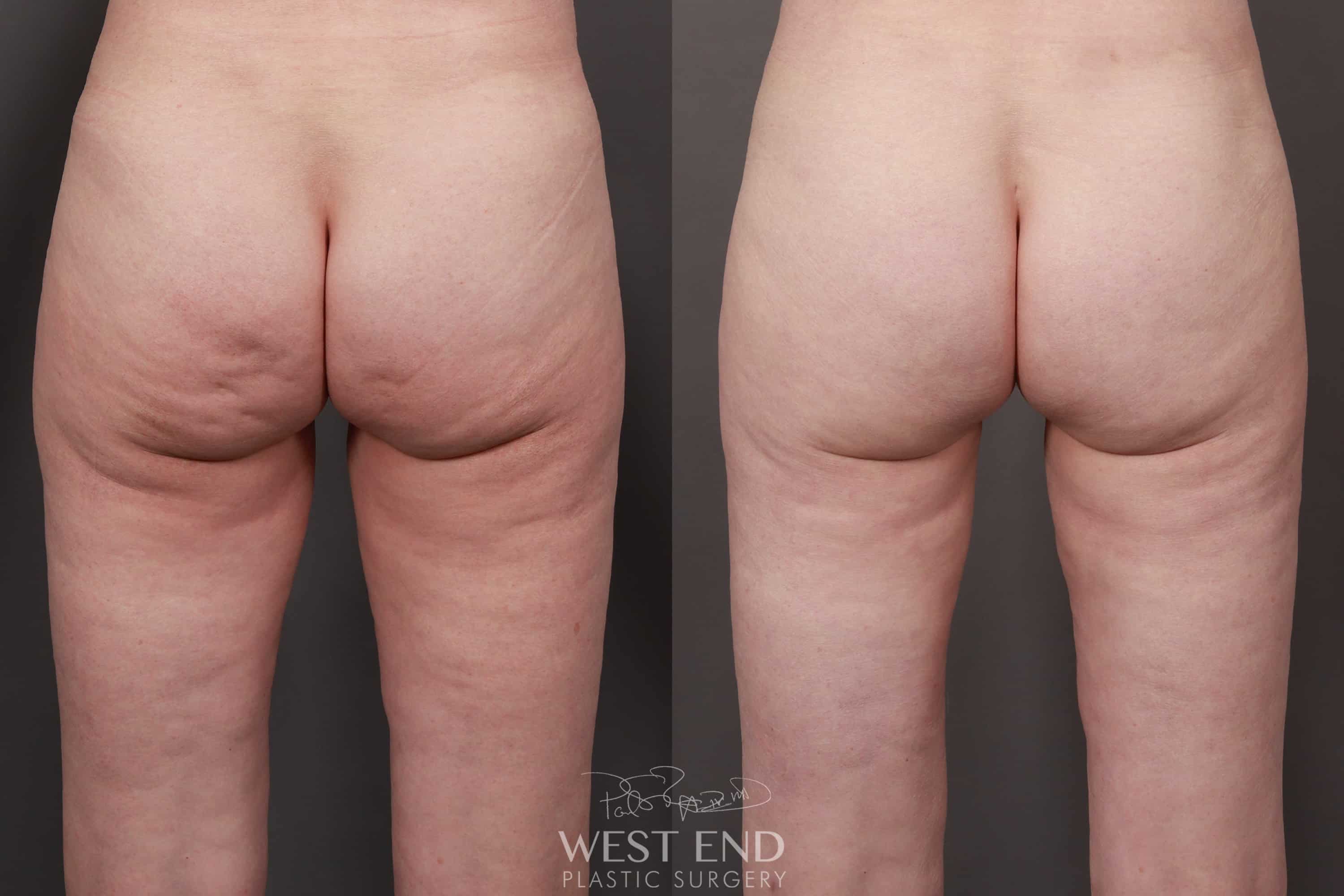 Liposuction, Renuvion, & Buttock Dimple Release with Focused Fat Grafting