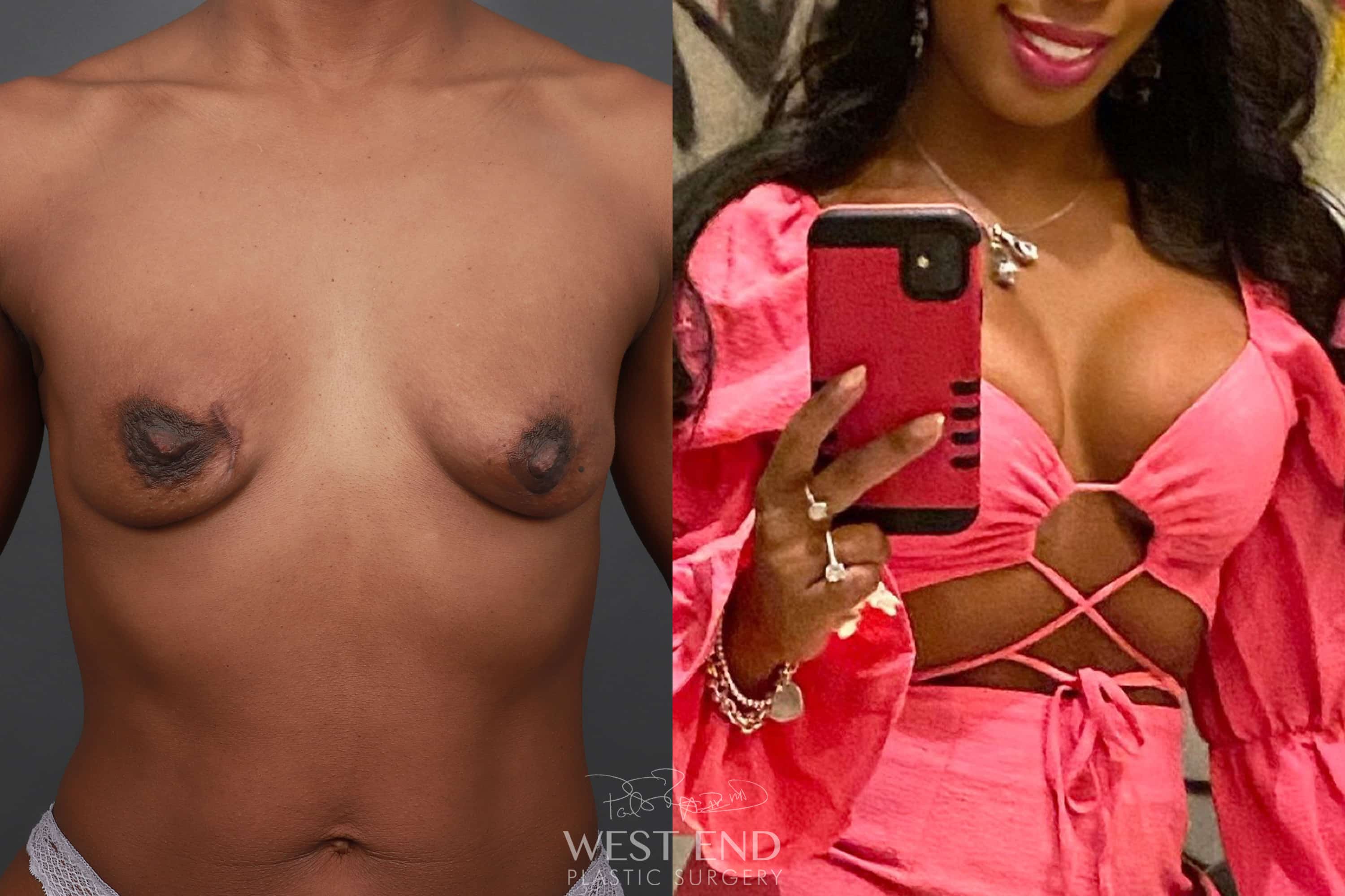 Breast Augmentation before photo. Individual results may vary.