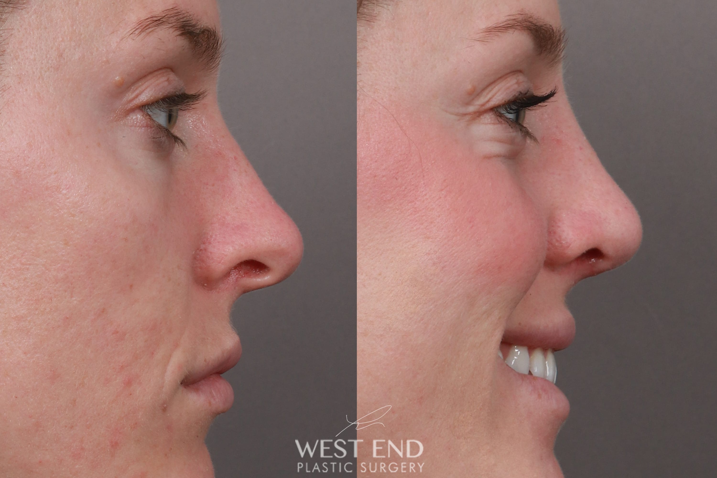Rhinoplasty (1 Month Post-Op) before photo. Individual results may vary.