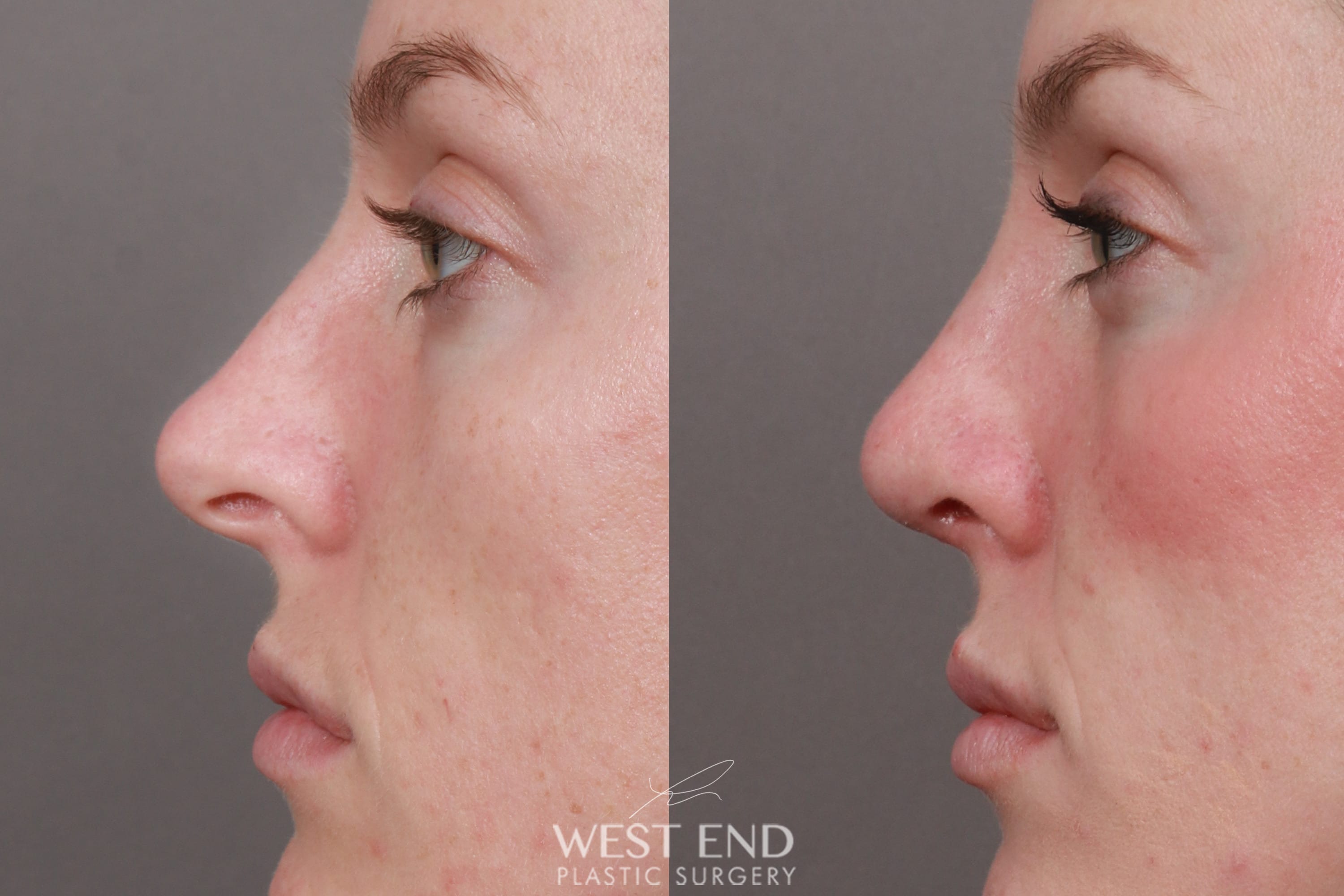 Rhinoplasty (1 Month Post-Op) before photo. Individual results may vary.