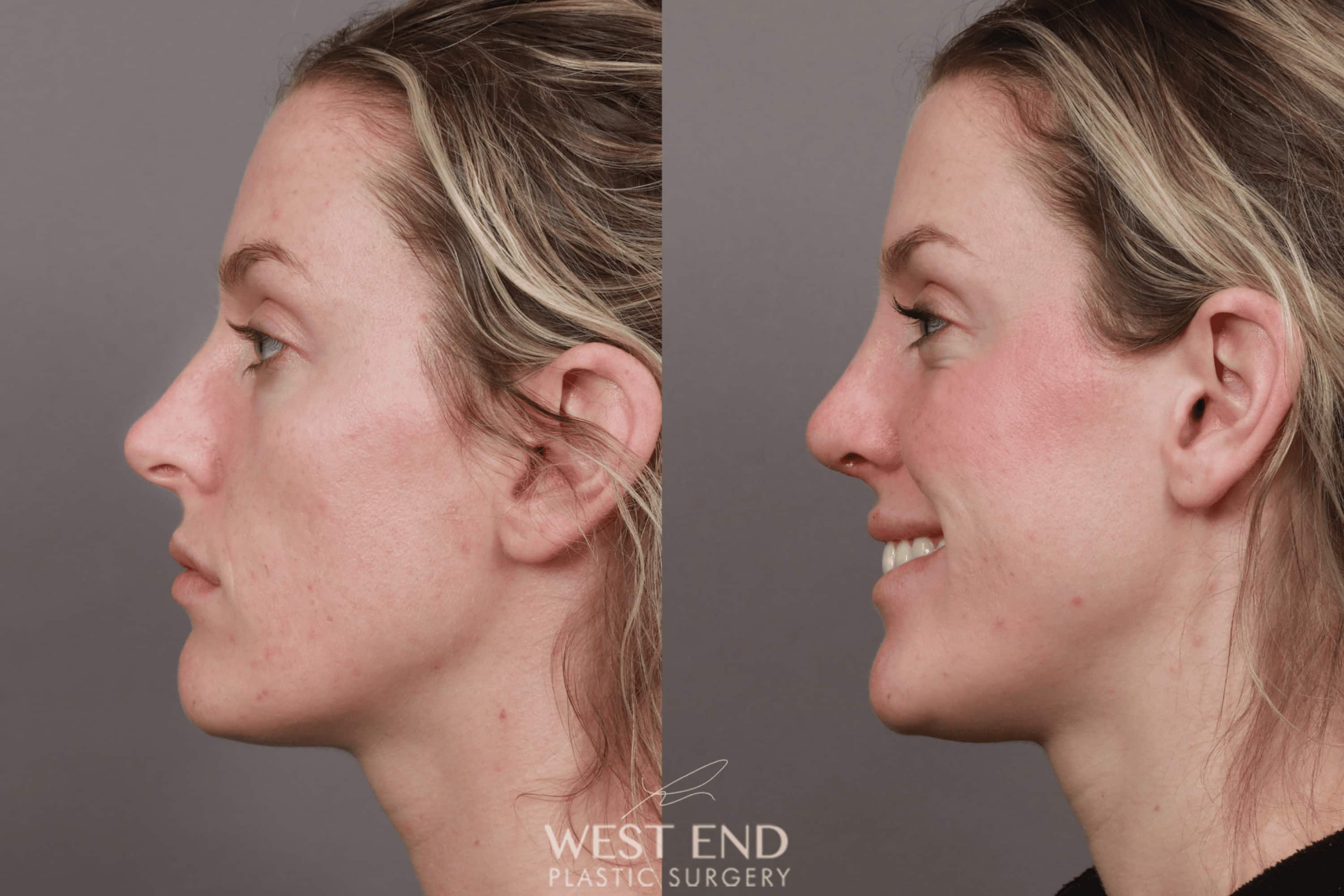Rhinoplasty (1 Month Post-Op) before photo. Individual results may vary.