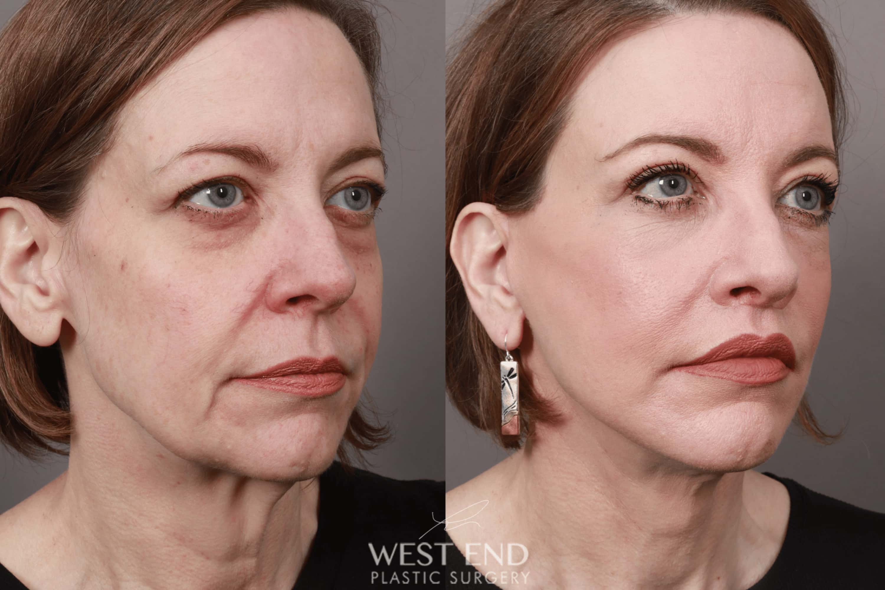 Deep Plane Facelift & Neck Lift, Lip Lift, Eyelid Lift, Brow Lift, Fat Grafting, and CO2 Resurfacing (1.5 Months Post-Op) before photo. Individual results may vary.