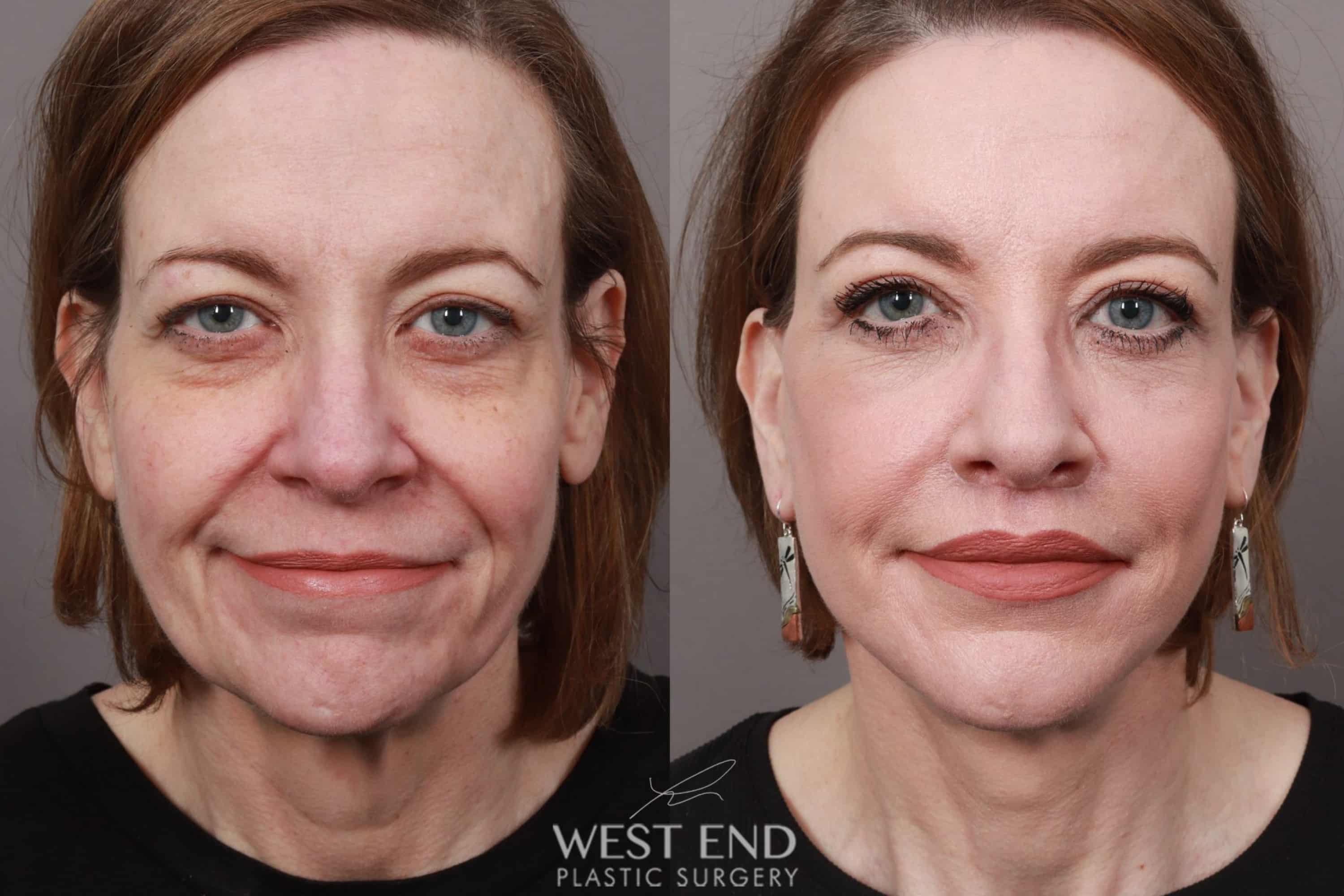 Deep Plane Facelift & Neck Lift, Lip Lift, Eyelid Lift, Brow Lift, Fat Grafting, and CO2 Resurfacing (1.5 Months Post-Op) before photo. Individual results may vary.